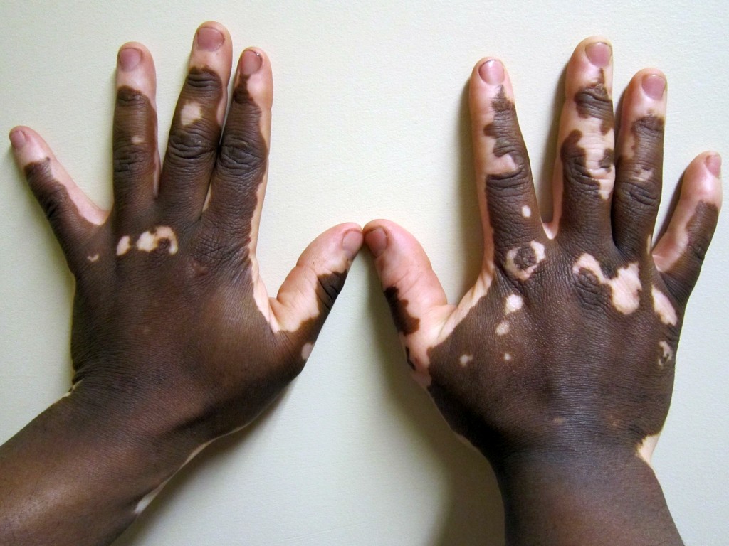 vitiligo-2